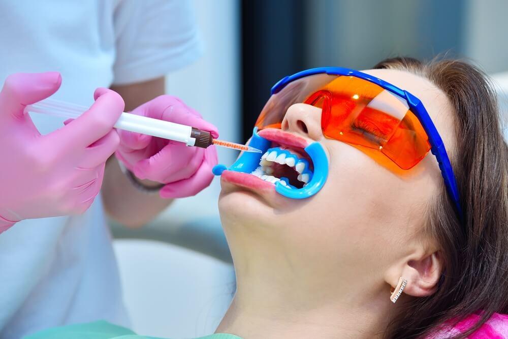 benefits of laser teeth whitening