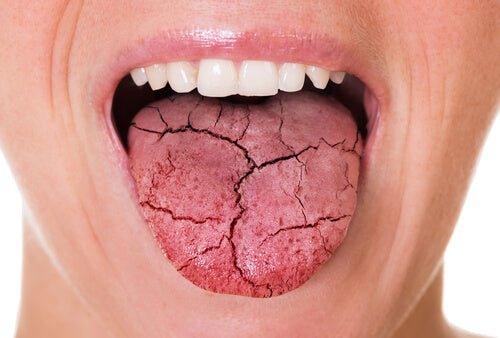 how to get rid of dry mouth