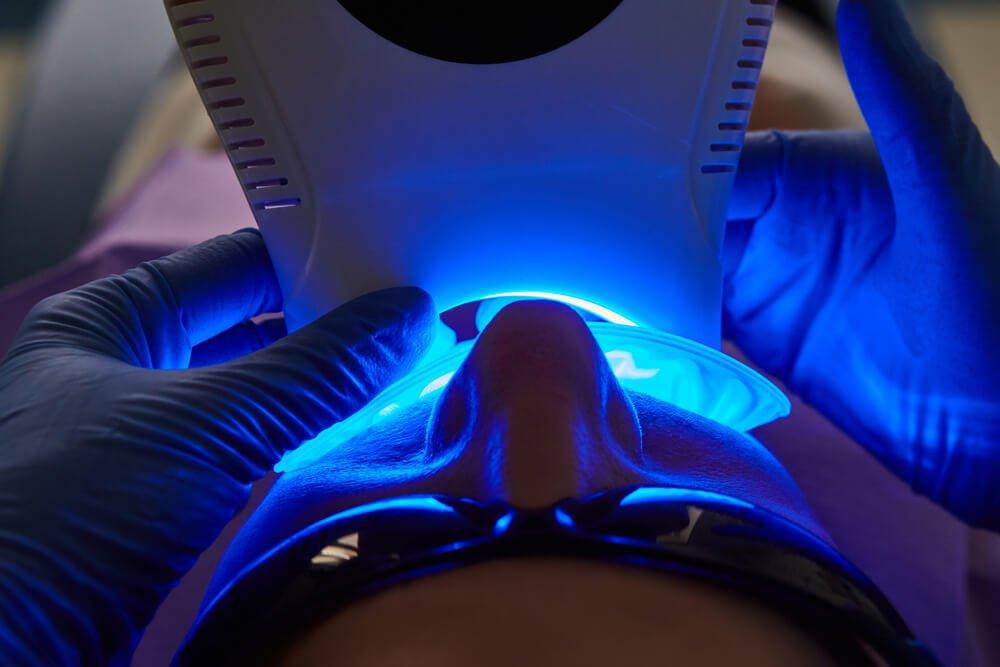 blue light teeth whitening