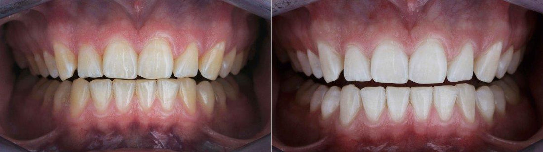 laserglow teeth whitening before and after pictures