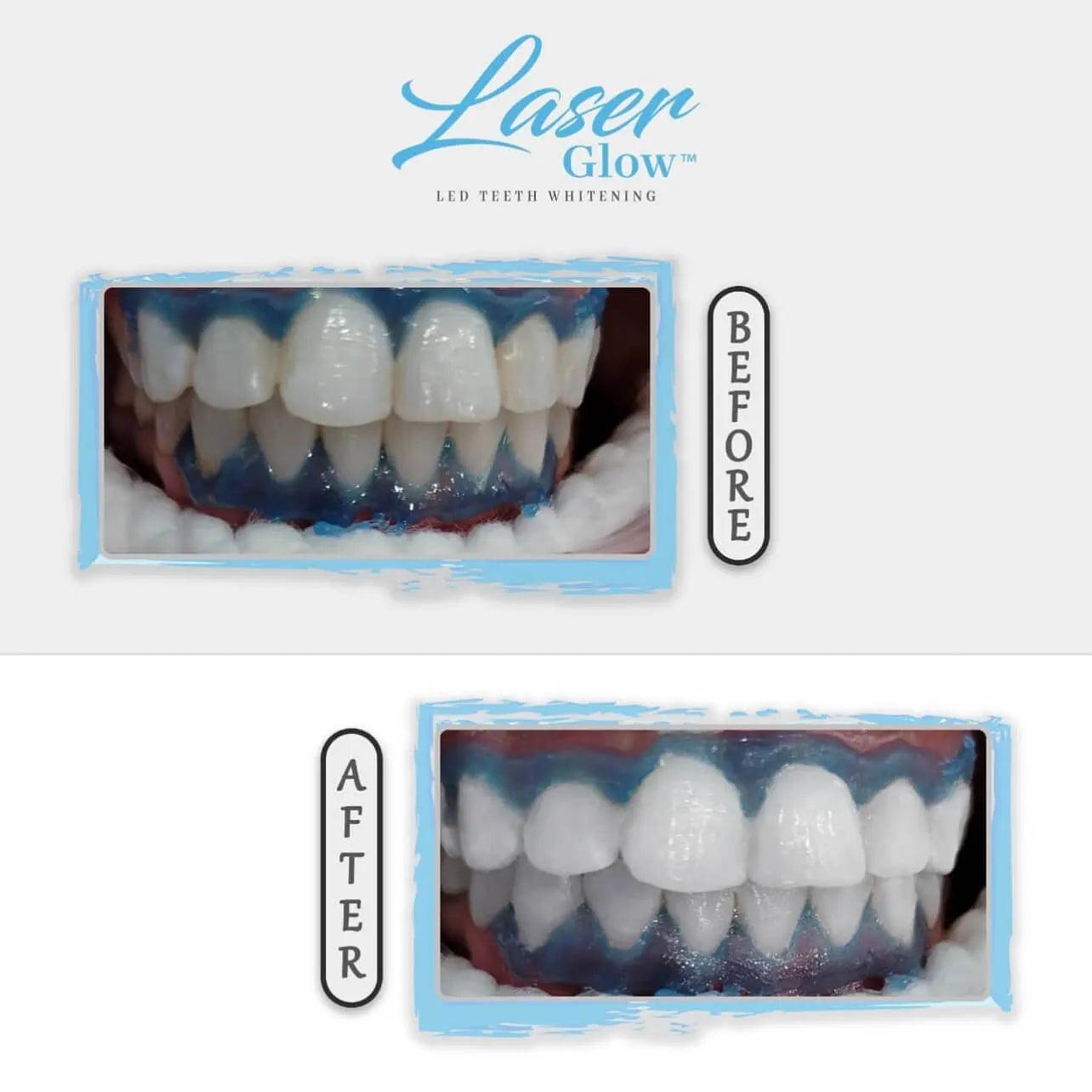 16% hydrogen peroxide teeth whitening gel