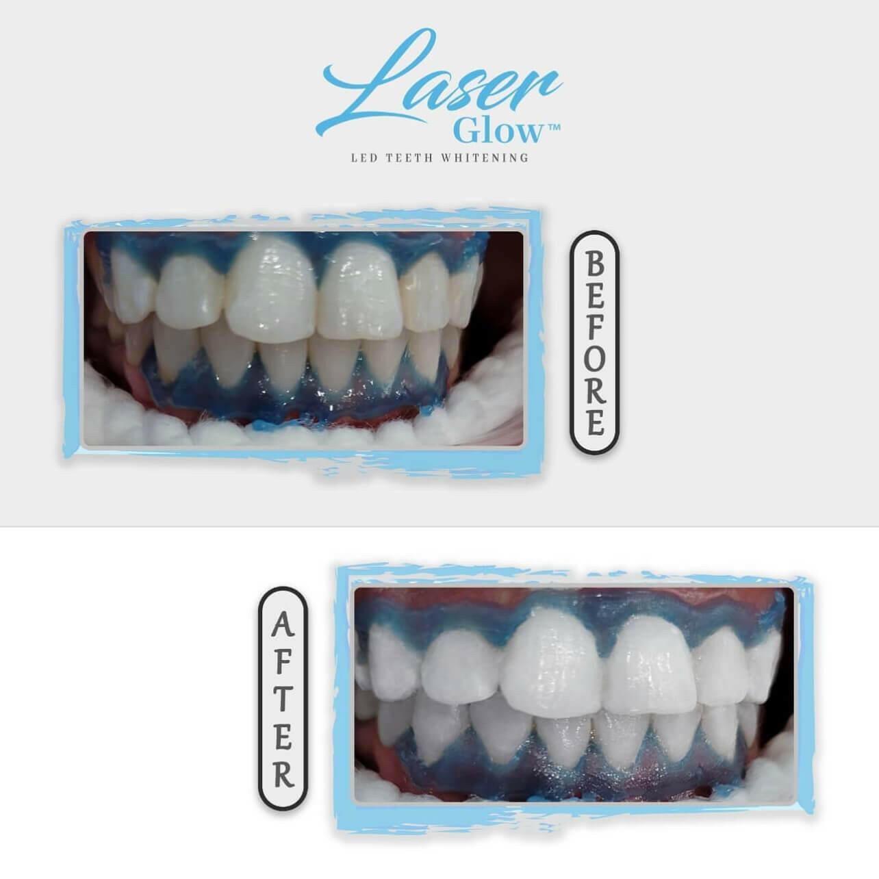 laserglow teeth whitening gum protection