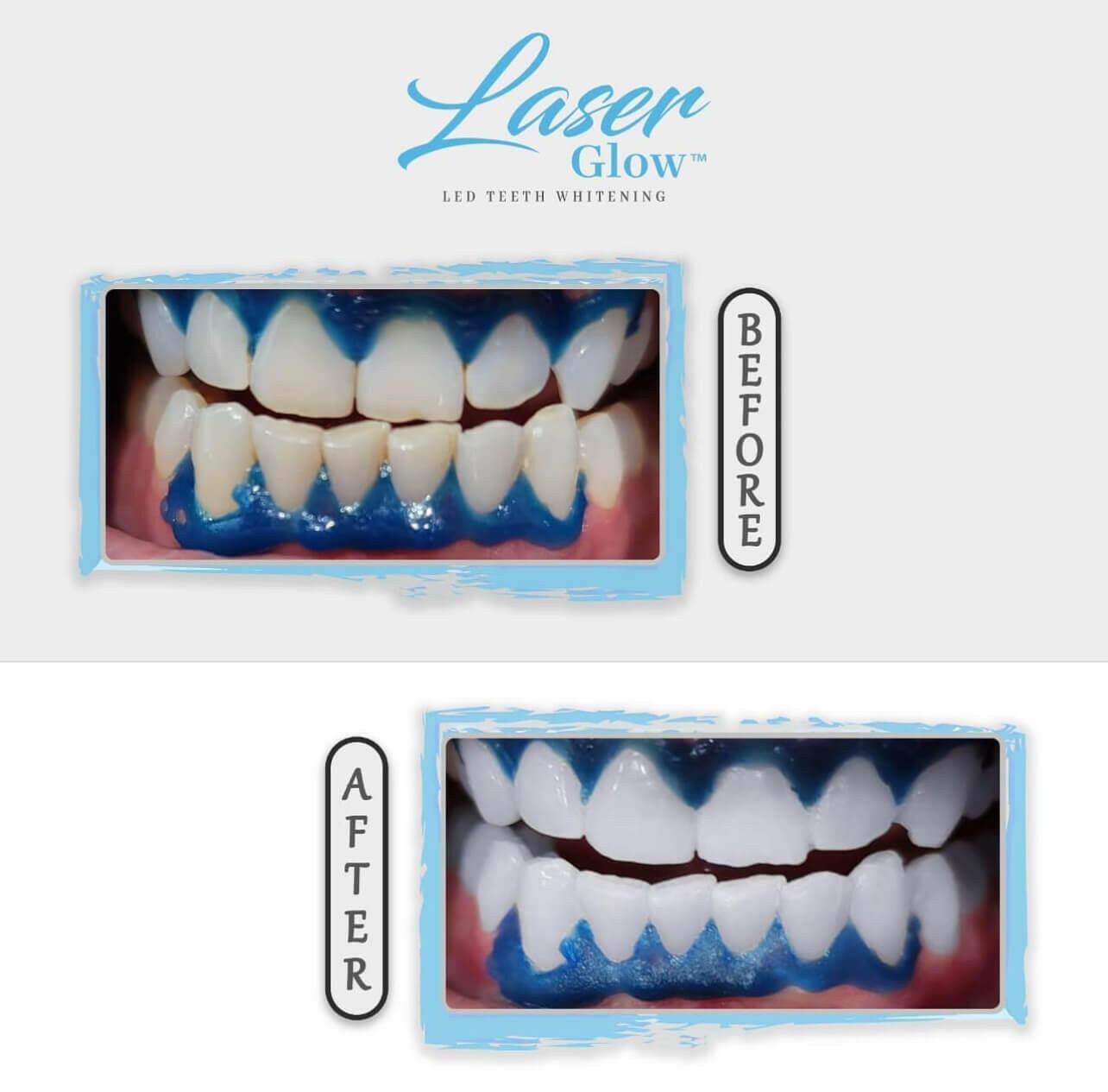 laserglow gingival barrier applicator